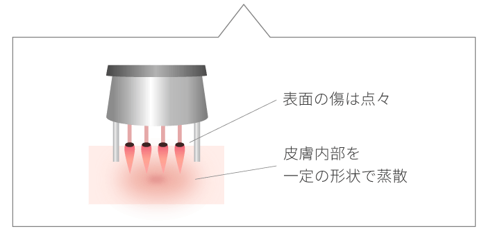 CO2フラクショナルレーザーのメカニズム
