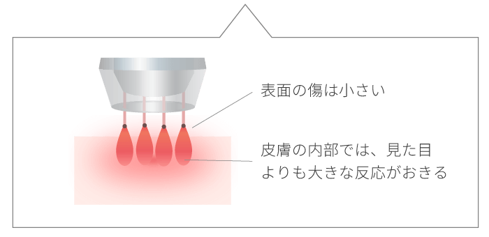 RFフラクショナルレーザーのメカニズム