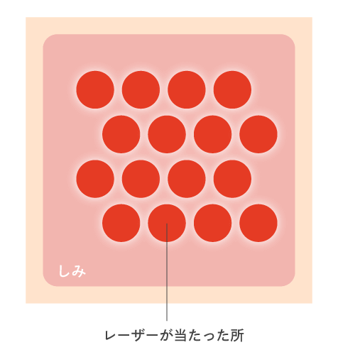 ピコレーザーのイラスト