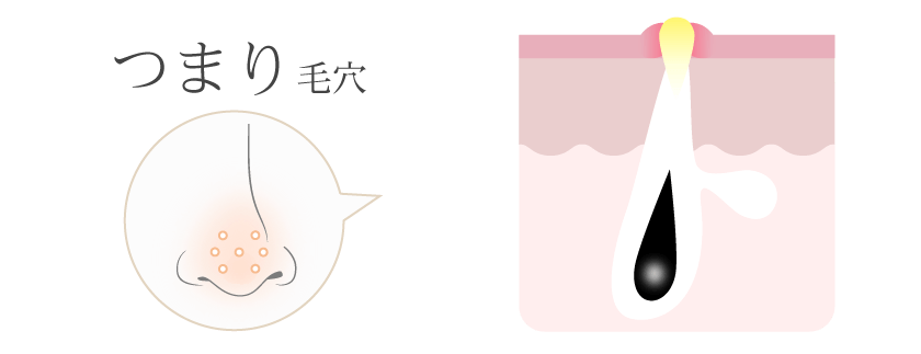 つまり毛穴
