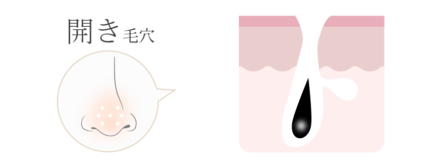 開き毛穴
