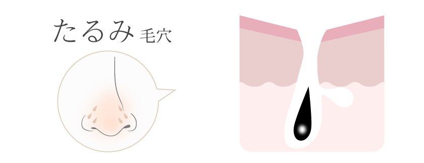 たるみ毛穴