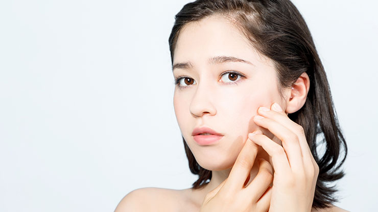 ニキビに悩む女性